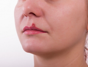 49866888 - girl lip diseased herpes. scabs on the stage of drying