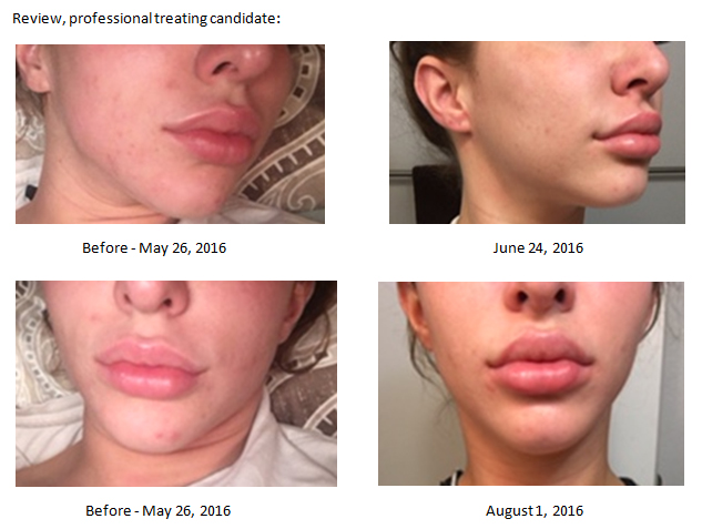 Review - NeoGenesis Recovery for Acne